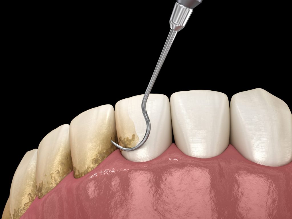 Deep Cleaning for Healthier Gums: What to Know About Scaling and Root Planing