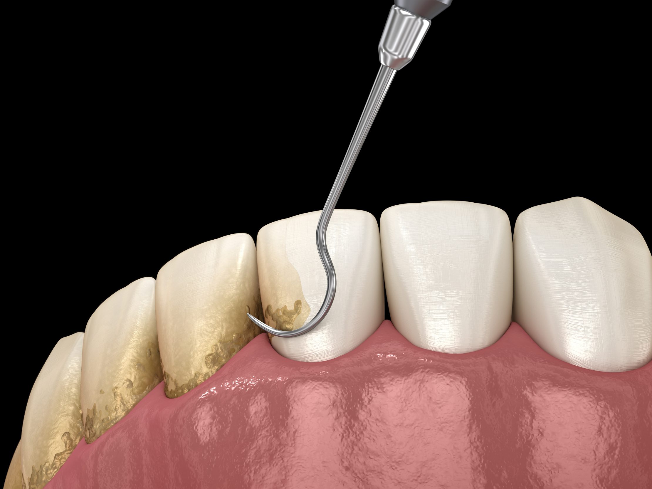 Deep Cleaning for Healthier Gums: What to Know About Scaling and Root Planing