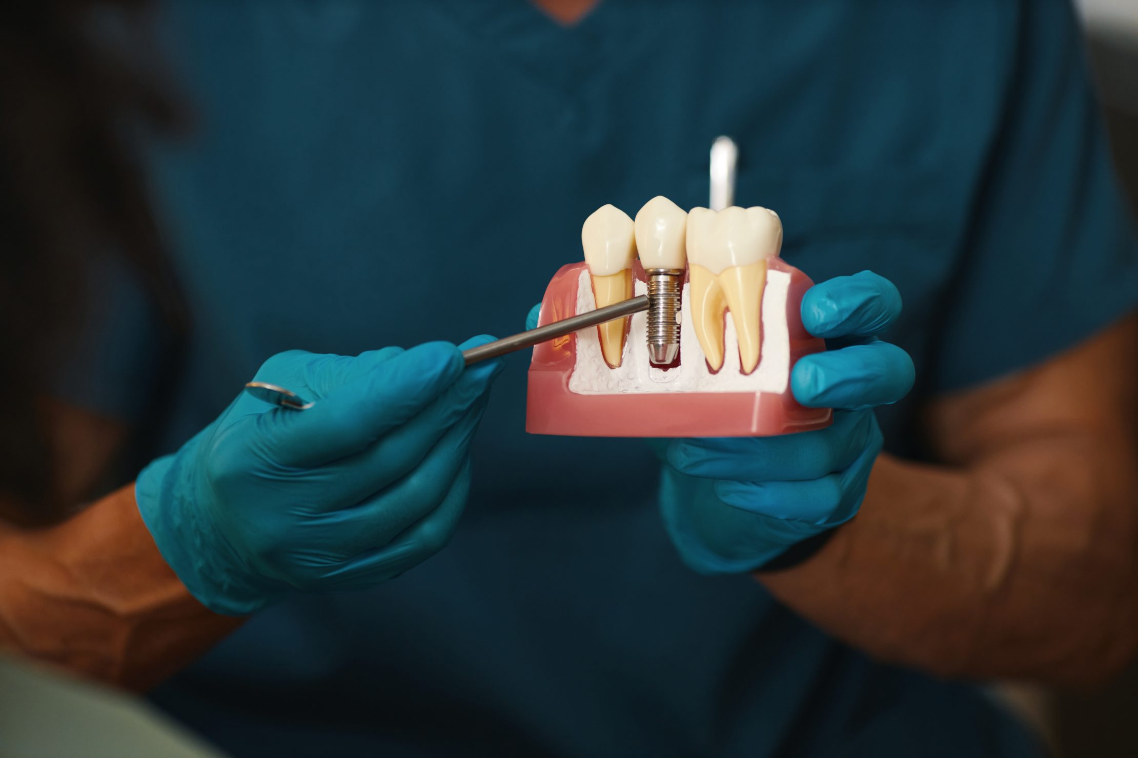 Dental Implants vs. Bridges: Your Best Path Forward